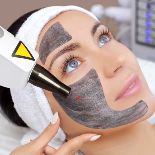 image of the Carbon Peeling treatment